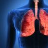 ¿Qué es la tuberculosis pulmonar activa?