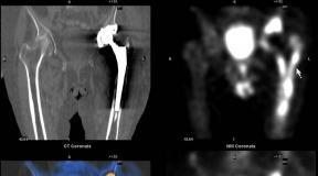Osteosintiqrafiya (OSG), sintiqrafiya, skelet sümüklərinin skan edilməsi