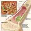 Xroniki osteomielit: səbəbləri, simptomları, diaqnozu, müalicəsi