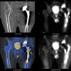 Osteosintiqrafiya (OSG), sintiqrafiya, skelet sümüklərinin skan edilməsi