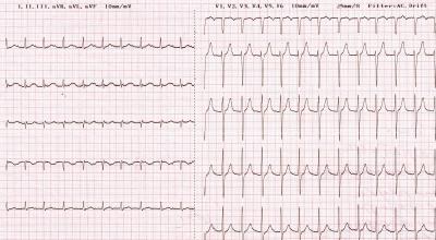 Diagnóstico de taquicardia en ECG Taquicardia paroxística ventricular