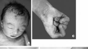Síndrome de Edwards: fotos, causas, diagnóstico, tratamiento Síndrome de Edwards en recién nacidos.