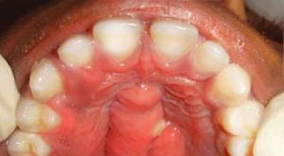 Periostitis del diente: tipos, causas, síntomas y tratamiento.