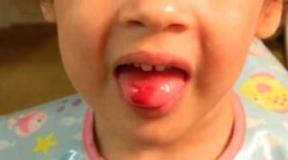 My child bit his tongue, what should I do?